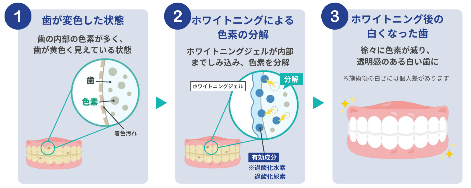 歯が変色した状態から、ホワイトニングジェルが色素を分解し、白い歯になるまでのメカニズム図